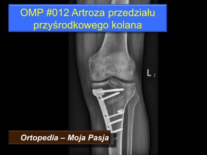 deformarea artrozei articulației genunchiului de 3 4 grade bolile articulare ale mâinilor determină tratamentul simptomelor